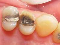 A Tooth with Cracked Tooth Syndrome A Tooth with Cracked Tooth Syndrome